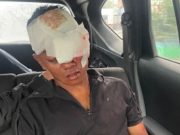 Prada Defliadi Korban Geng Motor Alami Buta Permanen